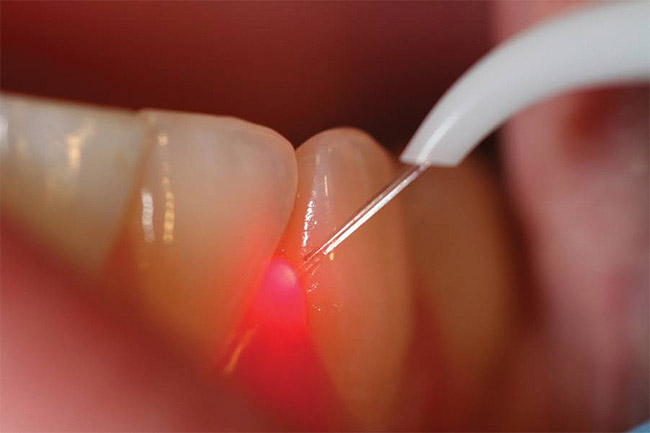 laser implant dentistry 