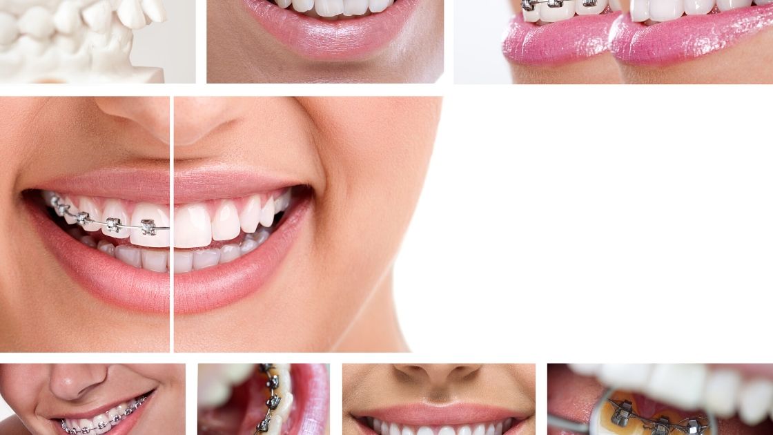 braces types