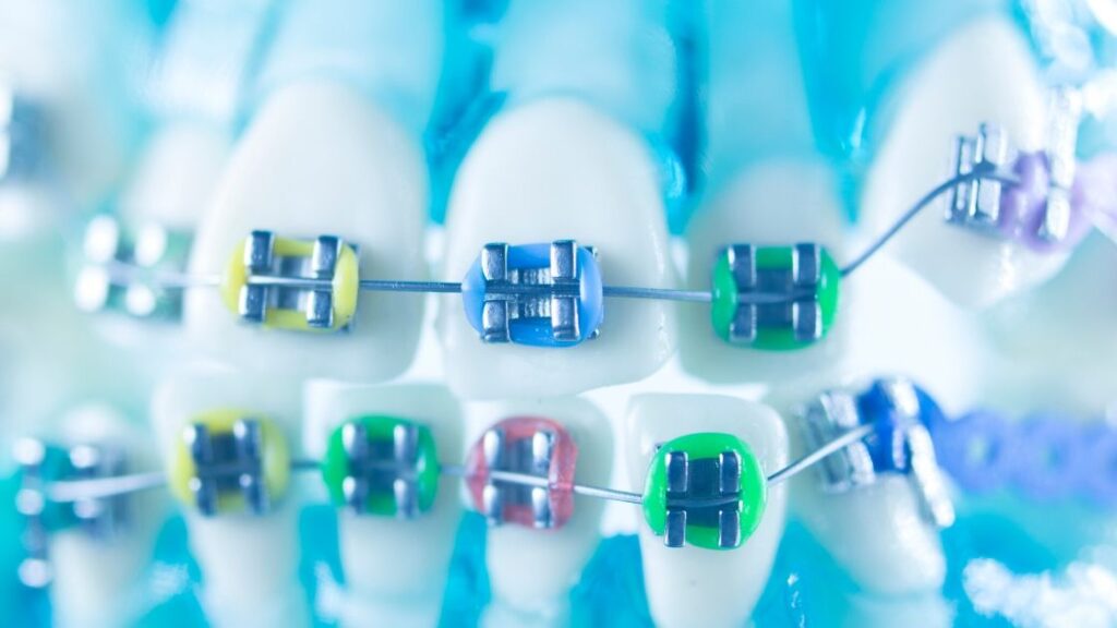 dental-braces-how